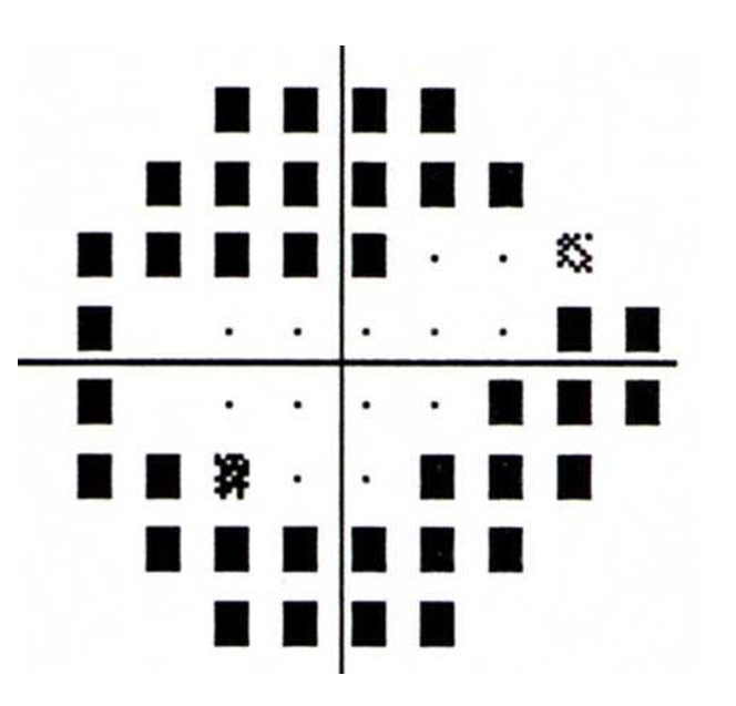 test results showing Superior and inferior visual field loss from glaucoma causing tunnel vision